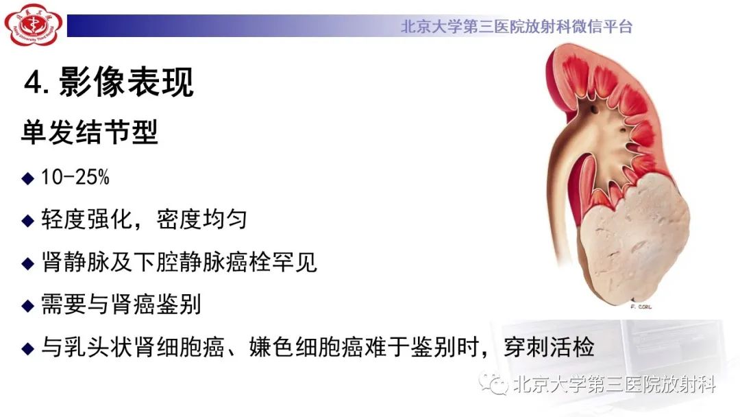 影像PPT - 【PPT】肾脏淋巴瘤-24
