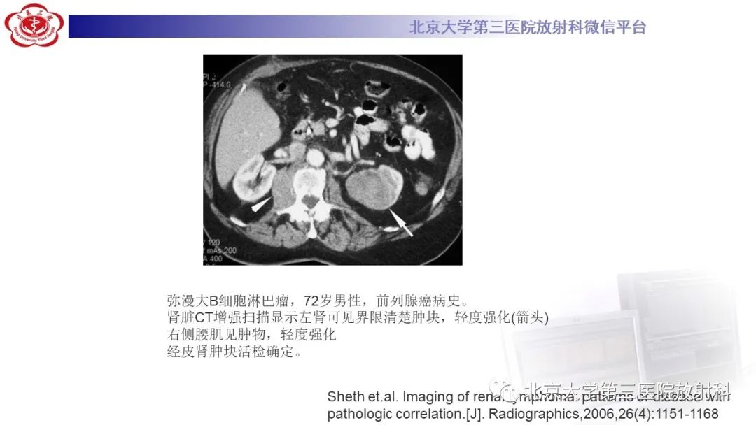影像PPT - 【PPT】肾脏淋巴瘤-25