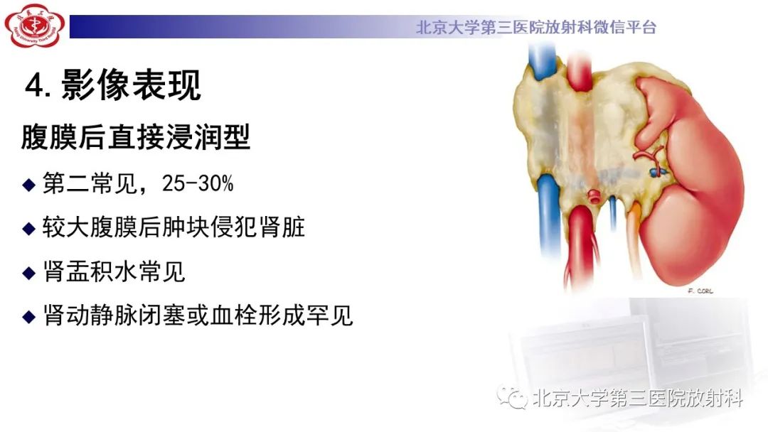 影像PPT - 【PPT】肾脏淋巴瘤-26