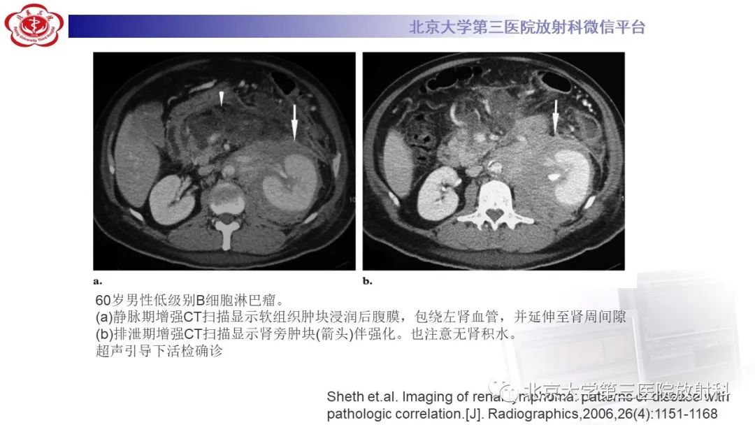 影像PPT - 【PPT】肾脏淋巴瘤-27