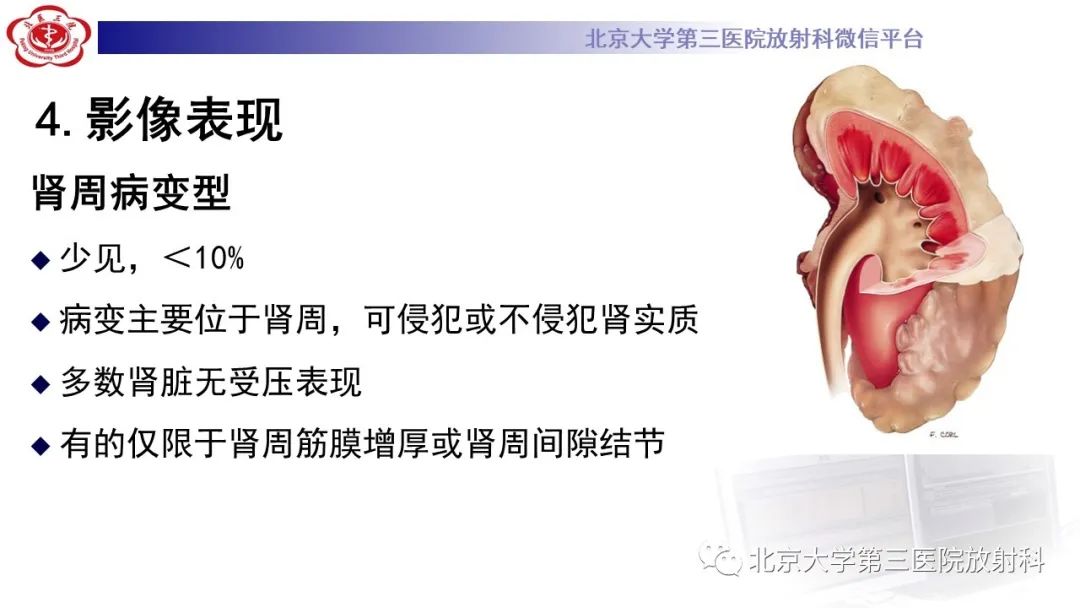 影像PPT - 【PPT】肾脏淋巴瘤-28