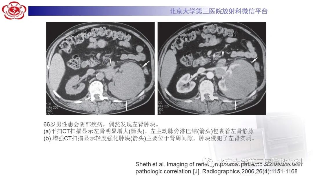 影像PPT - 【PPT】肾脏淋巴瘤-29
