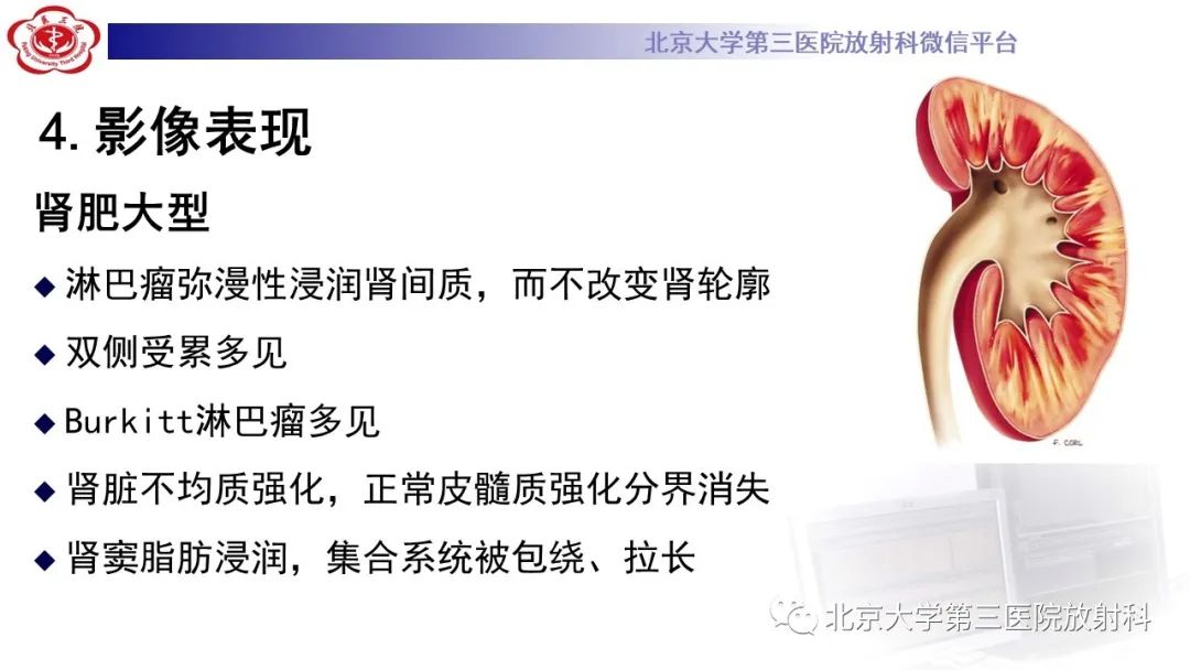 影像PPT - 【PPT】肾脏淋巴瘤-30