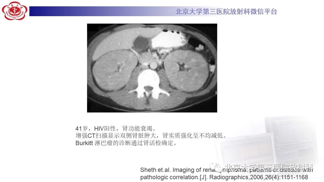 影像PPT - 【PPT】肾脏淋巴瘤-31