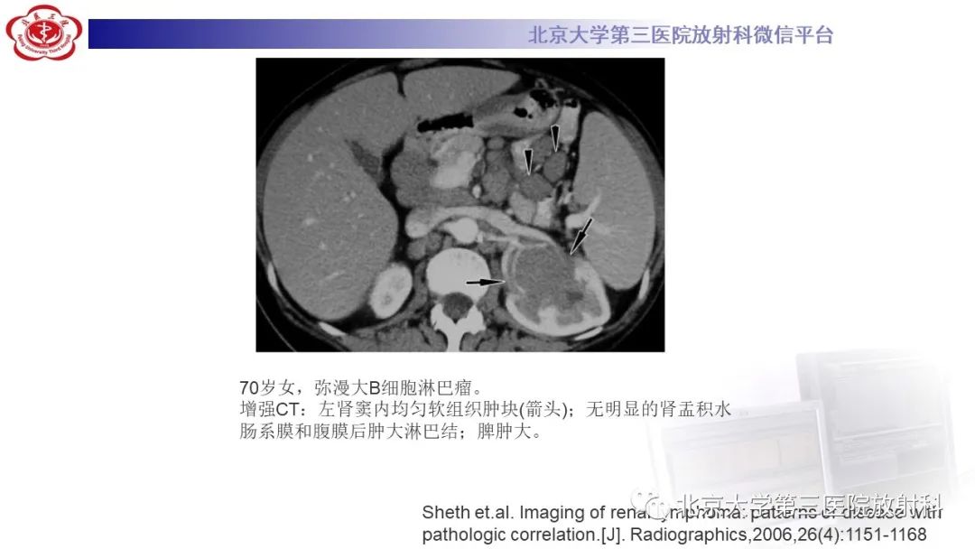 影像PPT - 【PPT】肾脏淋巴瘤-33