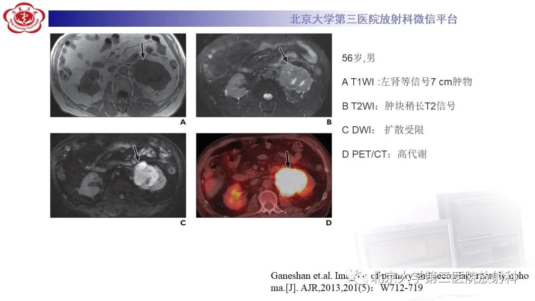 影像PPT - 【PPT】肾脏淋巴瘤-35