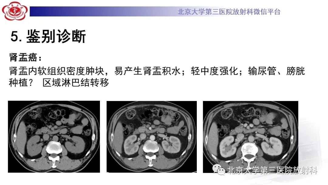影像PPT - 【PPT】肾脏淋巴瘤-36
