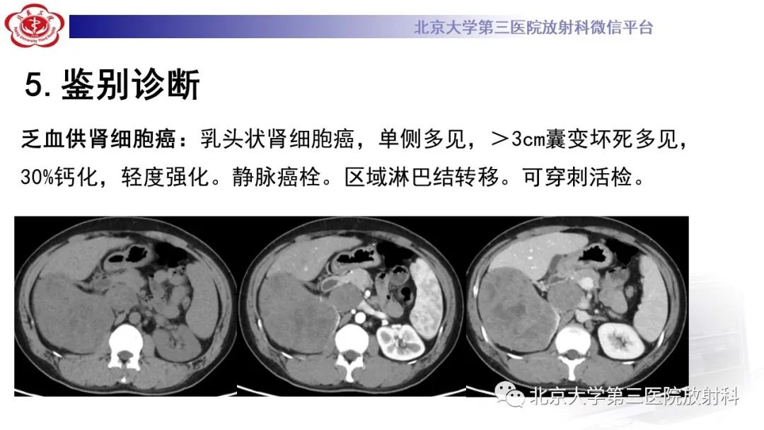 影像PPT - 【PPT】肾脏淋巴瘤-38