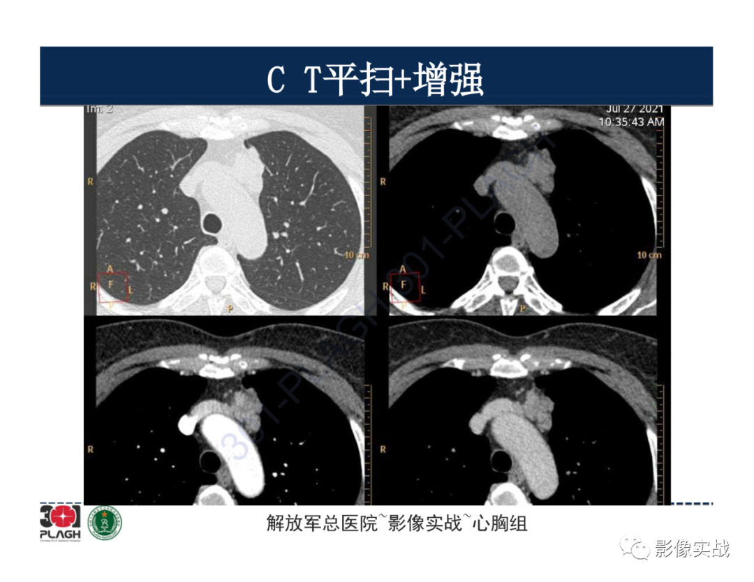 影像PPT - 【病例】胸腺瘤1例CT影像-4