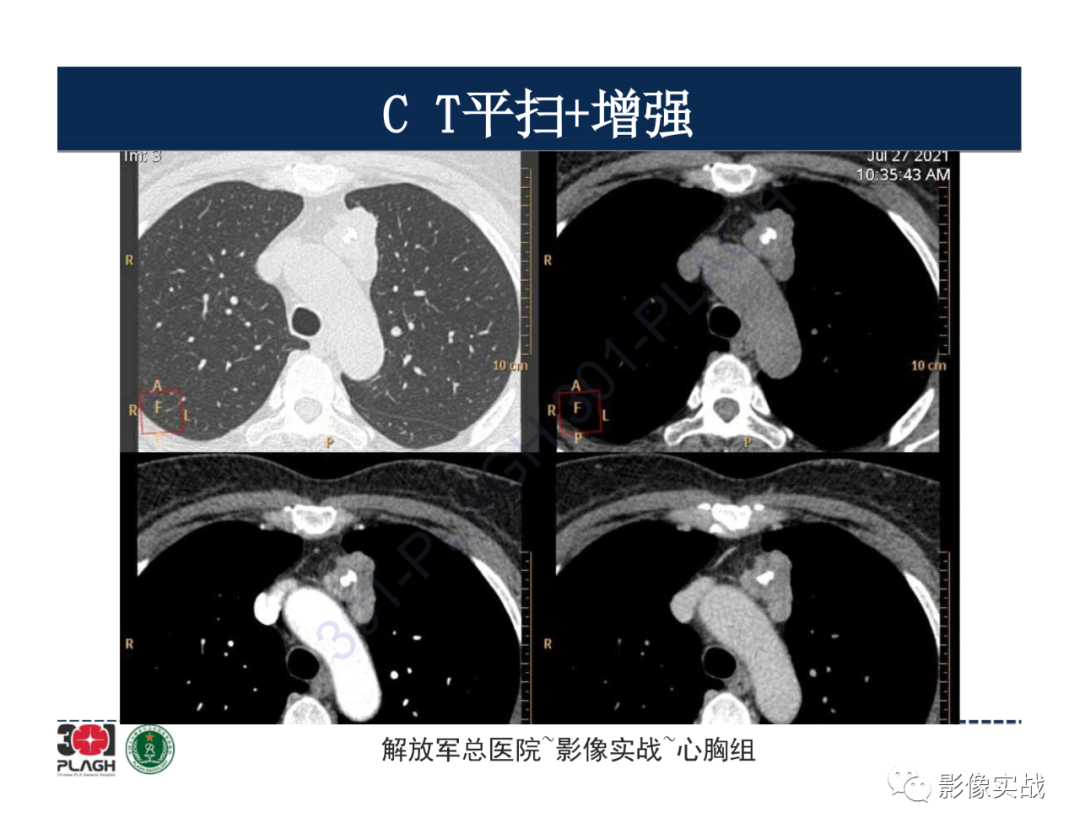 影像PPT - 【病例】胸腺瘤1例CT影像-5