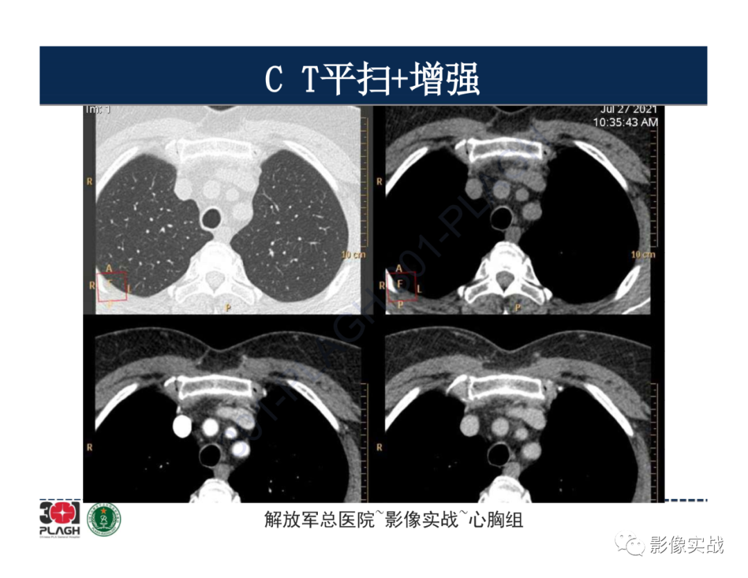 影像PPT - 【病例】胸腺瘤1例CT影像-3