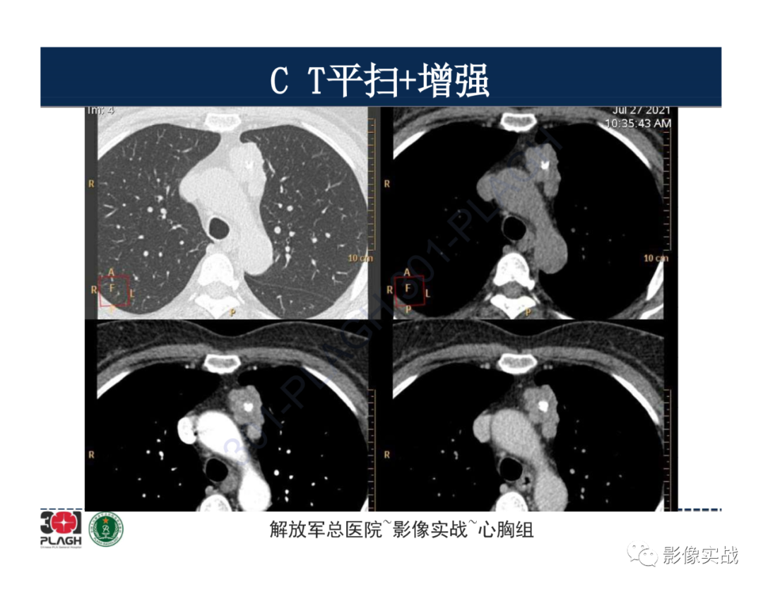影像PPT - 【病例】胸腺瘤1例CT影像-6