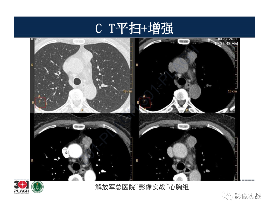 影像PPT - 【病例】胸腺瘤1例CT影像-7