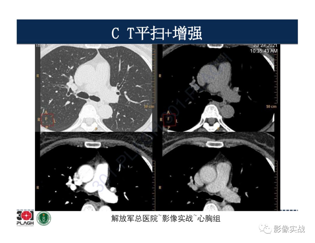 影像PPT - 【病例】胸腺瘤1例CT影像-8