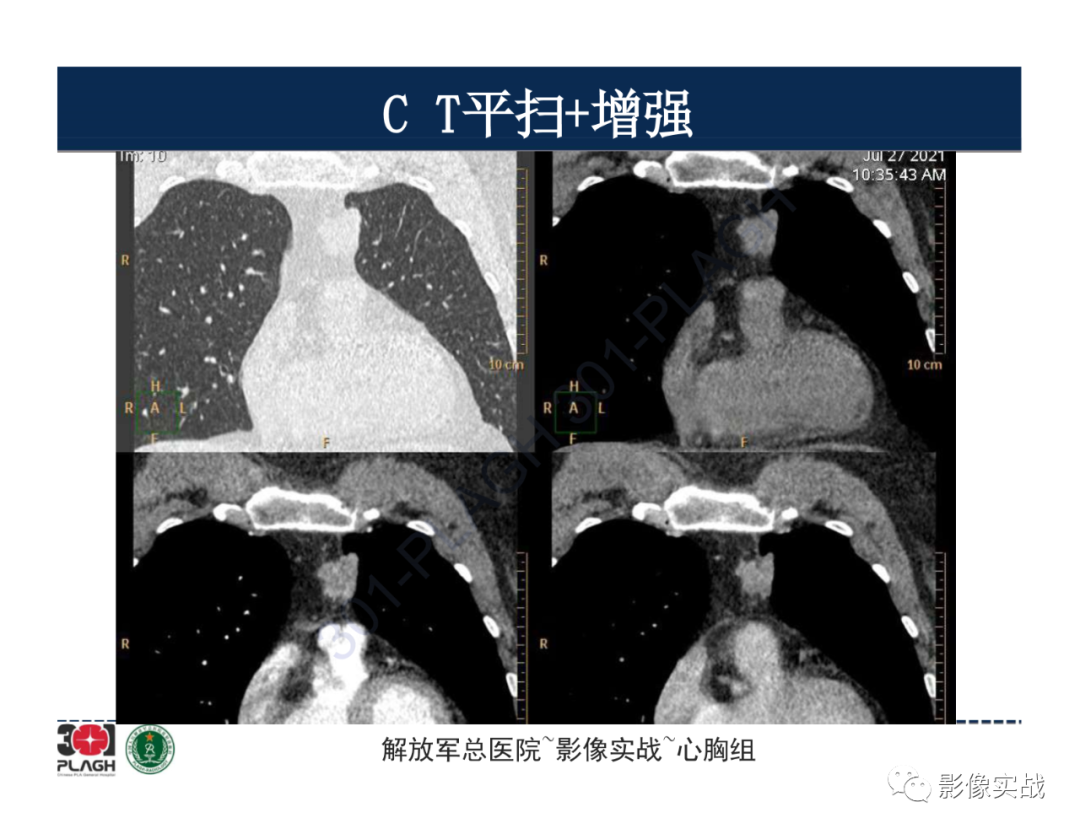 影像PPT - 【病例】胸腺瘤1例CT影像-9