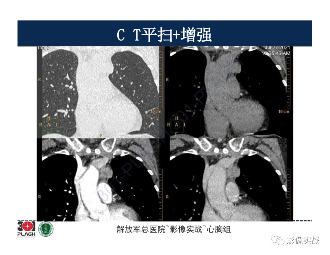 影像PPT - 【病例】胸腺瘤1例CT影像-10