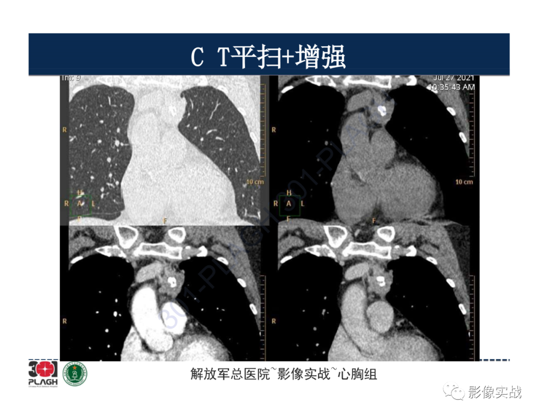 影像PPT - 【病例】胸腺瘤1例CT影像-11