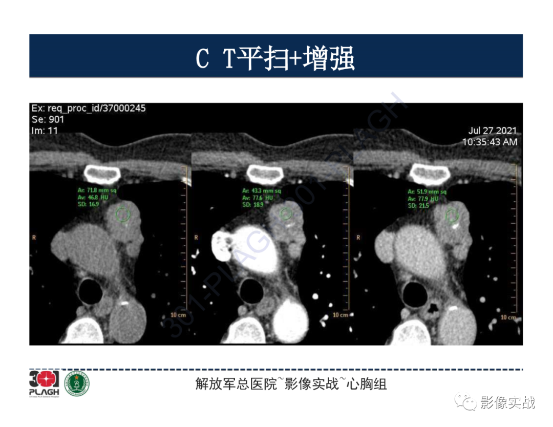 影像PPT - 【病例】胸腺瘤1例CT影像-13
