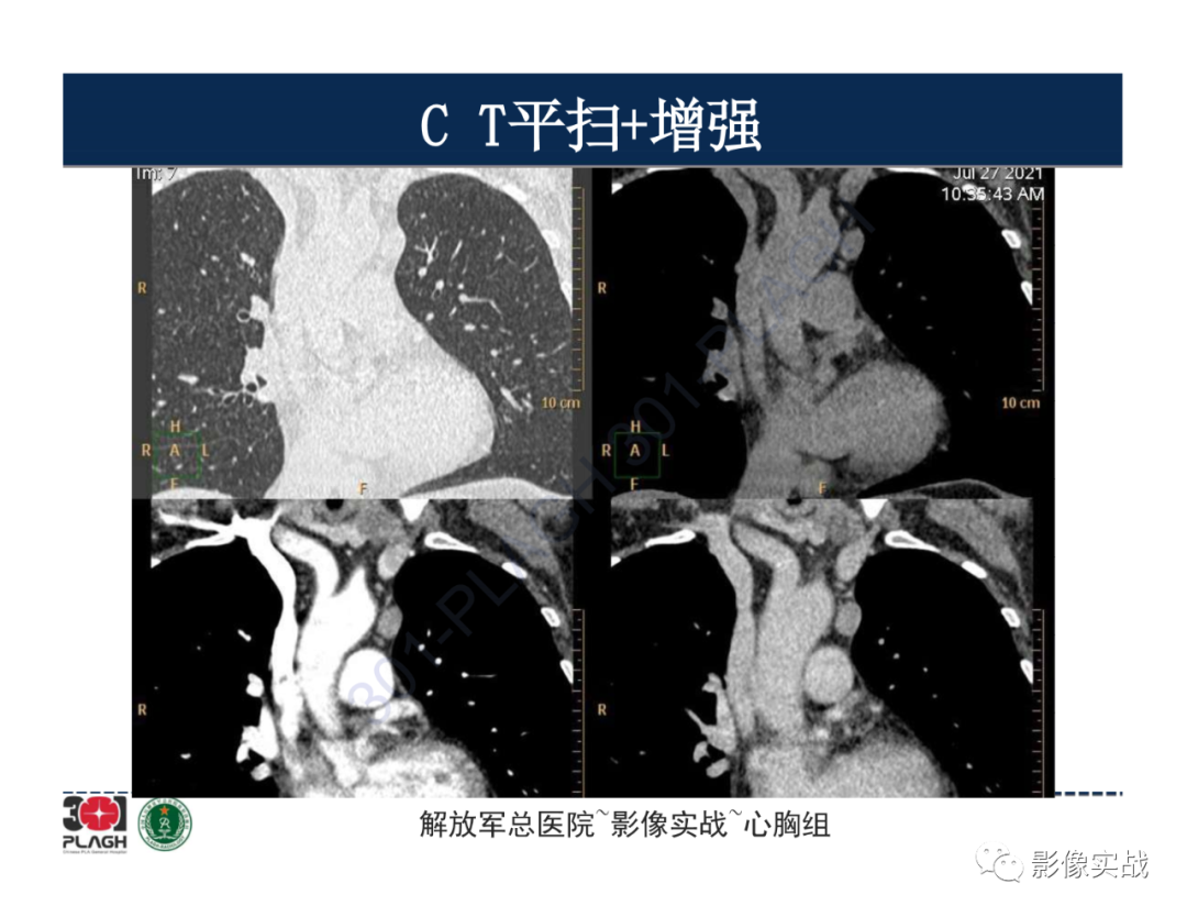 影像PPT - 【病例】胸腺瘤1例CT影像-12