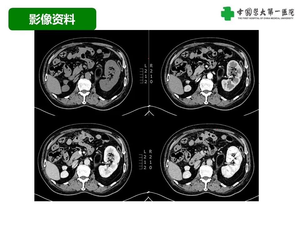 影像PPT - 【病例】腹膜后脂肪肉瘤1例CT影像-4