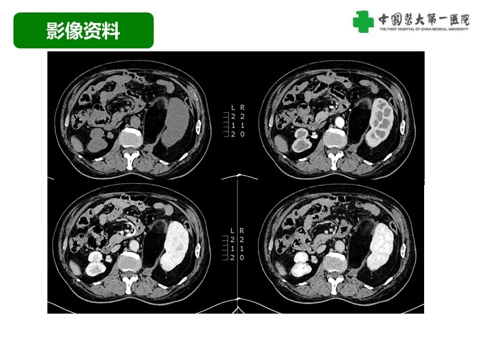 影像PPT - 【病例】腹膜后脂肪肉瘤1例CT影像-5