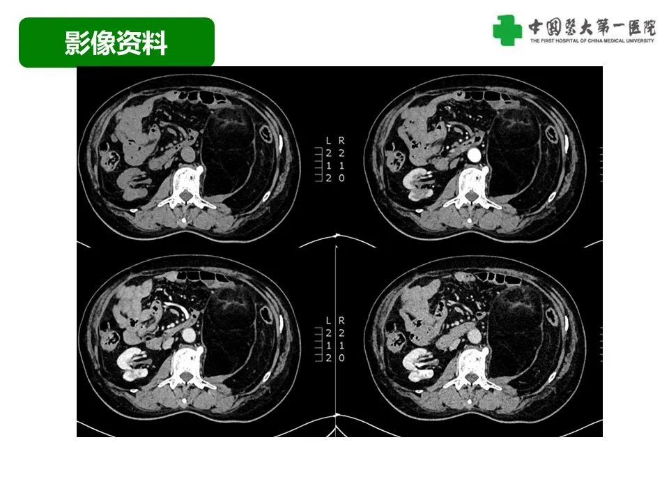 影像PPT - 【病例】腹膜后脂肪肉瘤1例CT影像-6