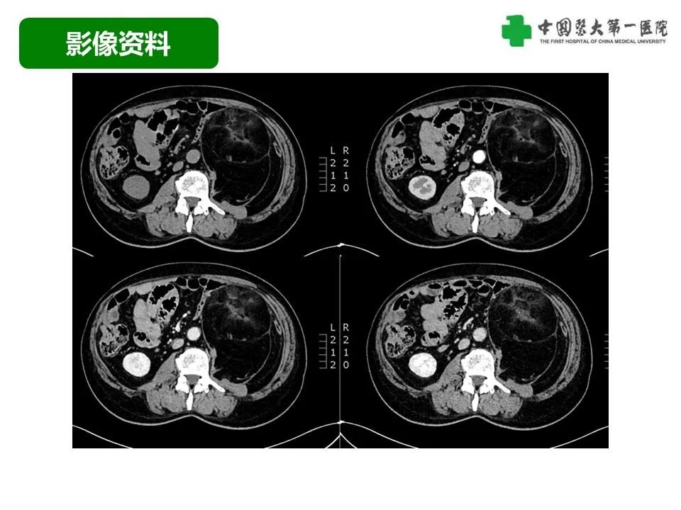 影像PPT - 【病例】腹膜后脂肪肉瘤1例CT影像-7