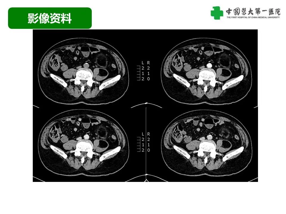 影像PPT - 【病例】腹膜后脂肪肉瘤1例CT影像-8