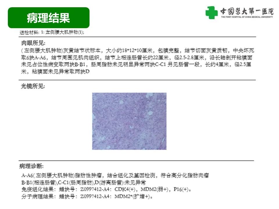 影像PPT - 【病例】腹膜后脂肪肉瘤1例CT影像-11