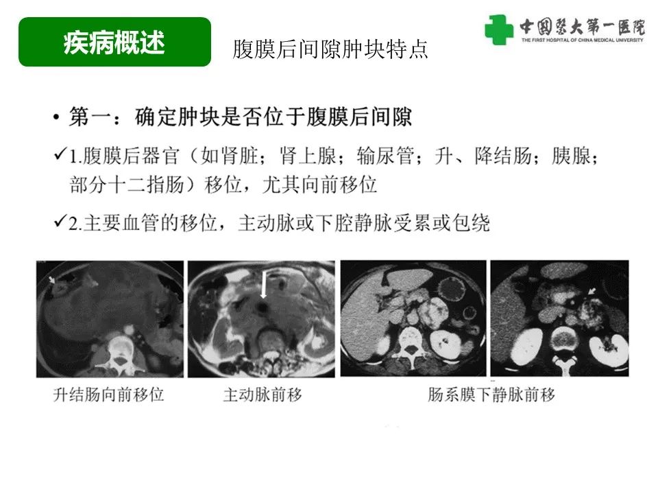 影像PPT - 【病例】腹膜后脂肪肉瘤1例CT影像-13