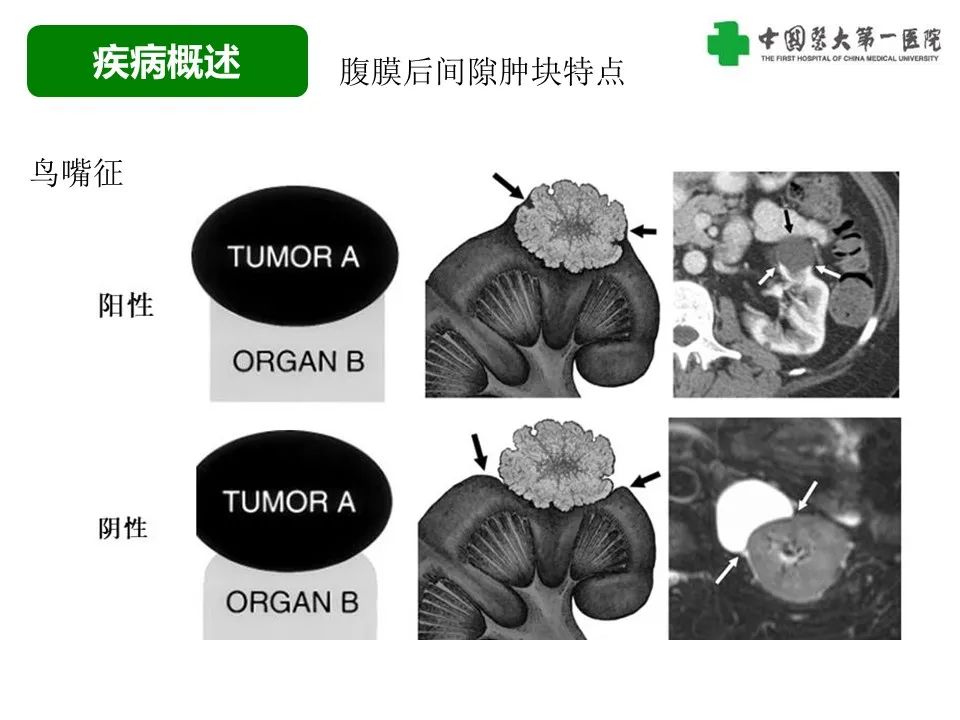 影像PPT - 【病例】腹膜后脂肪肉瘤1例CT影像-15