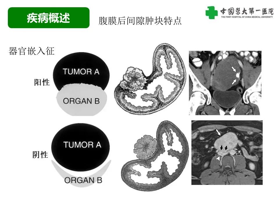 影像PPT - 【病例】腹膜后脂肪肉瘤1例CT影像-16