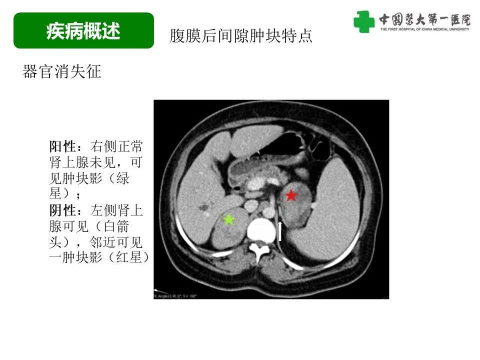 影像PPT - 【病例】腹膜后脂肪肉瘤1例CT影像-17