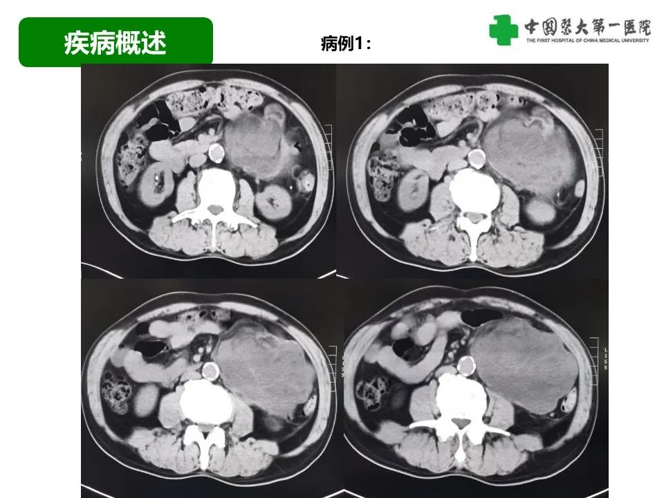 影像PPT - 【病例】腹膜后脂肪肉瘤1例CT影像-22