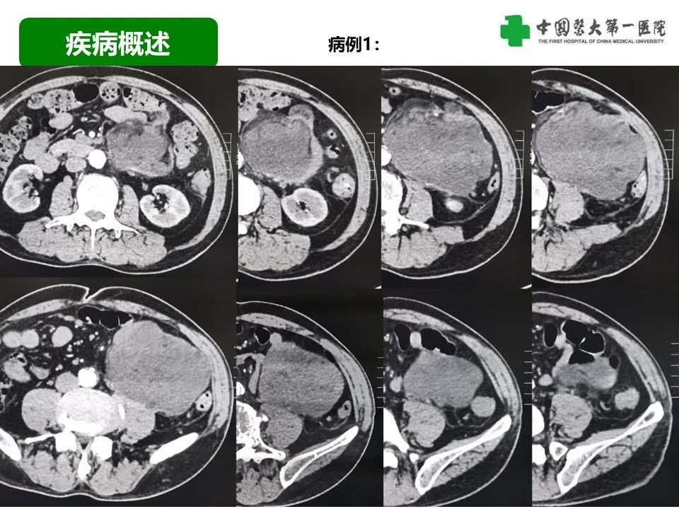 影像PPT - 【病例】腹膜后脂肪肉瘤1例CT影像-23