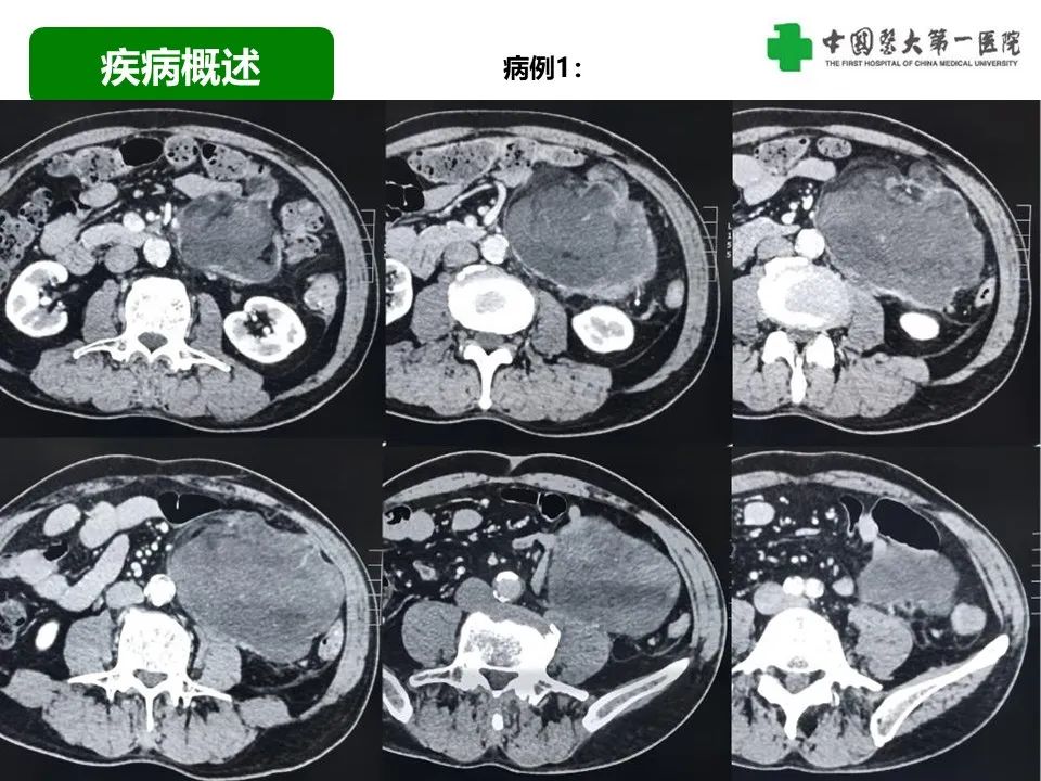 影像PPT - 【病例】腹膜后脂肪肉瘤1例CT影像-24