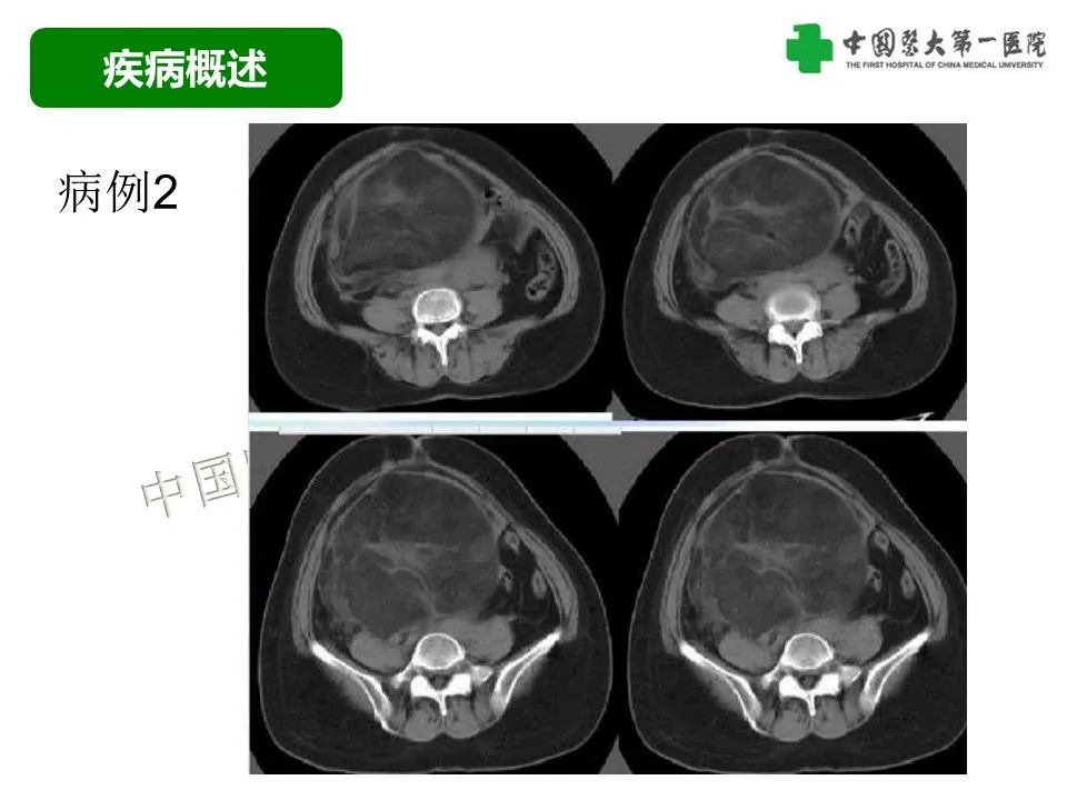 影像PPT - 【病例】腹膜后脂肪肉瘤1例CT影像-25