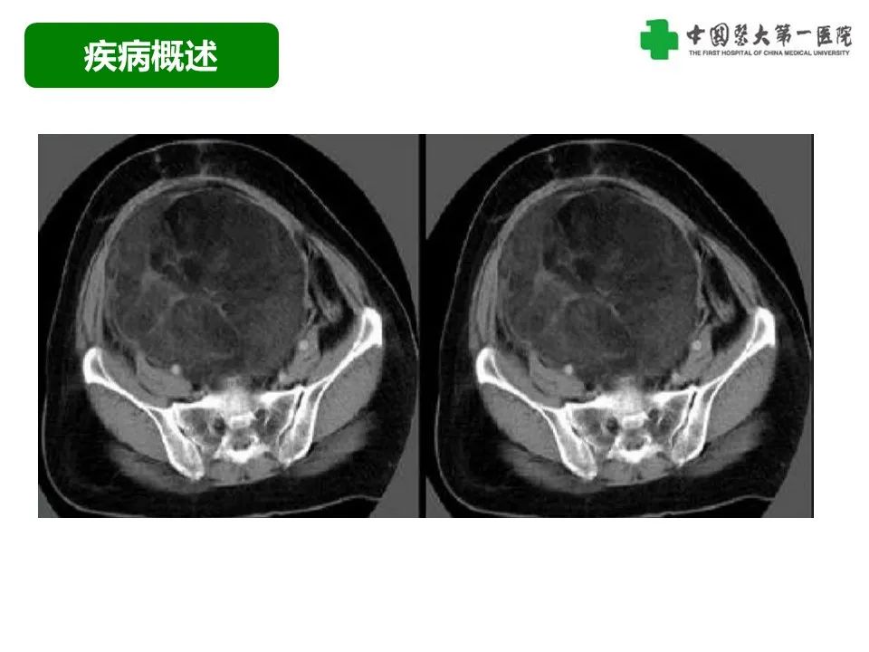 影像PPT - 【病例】腹膜后脂肪肉瘤1例CT影像-26