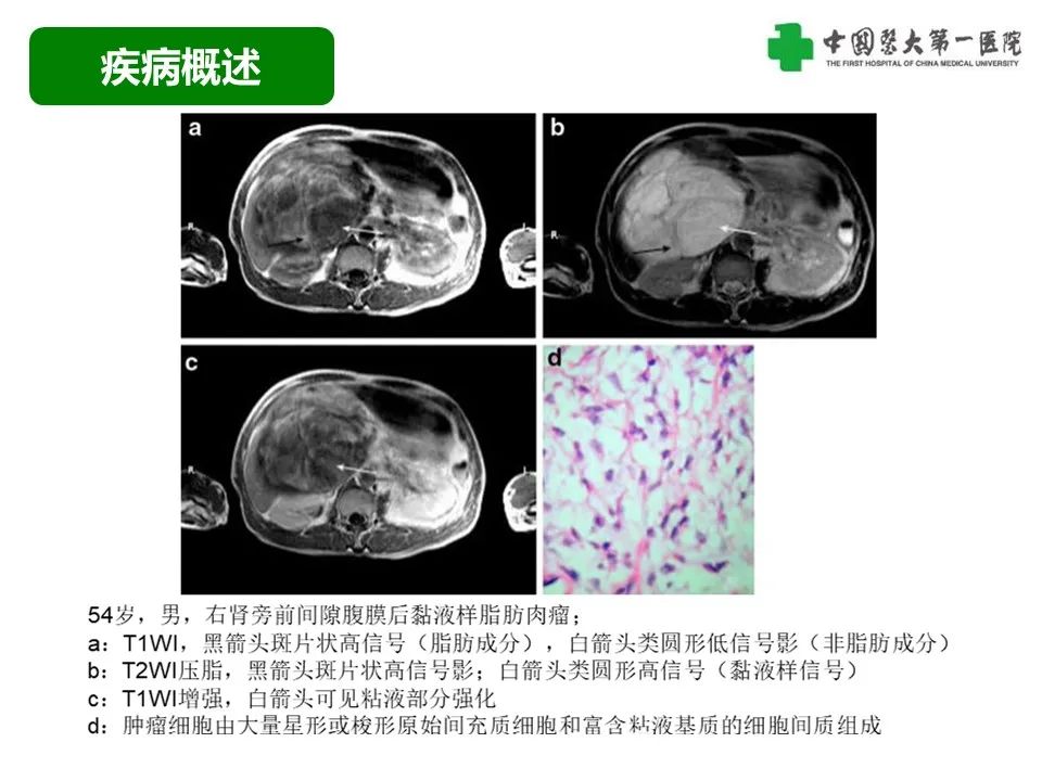 影像PPT - 【病例】腹膜后脂肪肉瘤1例CT影像-29