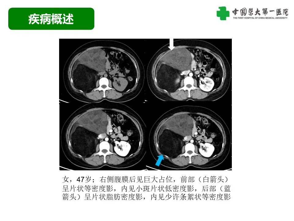 影像PPT - 【病例】腹膜后脂肪肉瘤1例CT影像-32