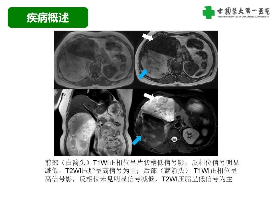 影像PPT - 【病例】腹膜后脂肪肉瘤1例CT影像-33