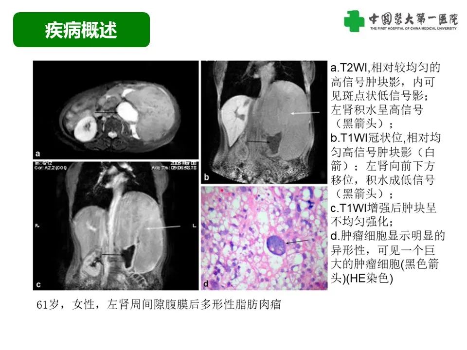 影像PPT - 【病例】腹膜后脂肪肉瘤1例CT影像-36