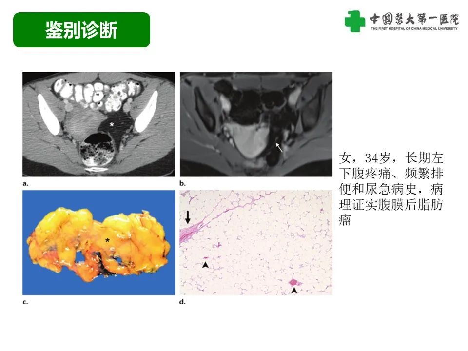 影像PPT - 【病例】腹膜后脂肪肉瘤1例CT影像-38