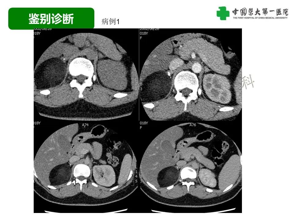 影像PPT - 【病例】腹膜后脂肪肉瘤1例CT影像-40