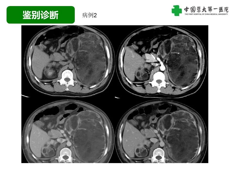 影像PPT - 【病例】腹膜后脂肪肉瘤1例CT影像-41