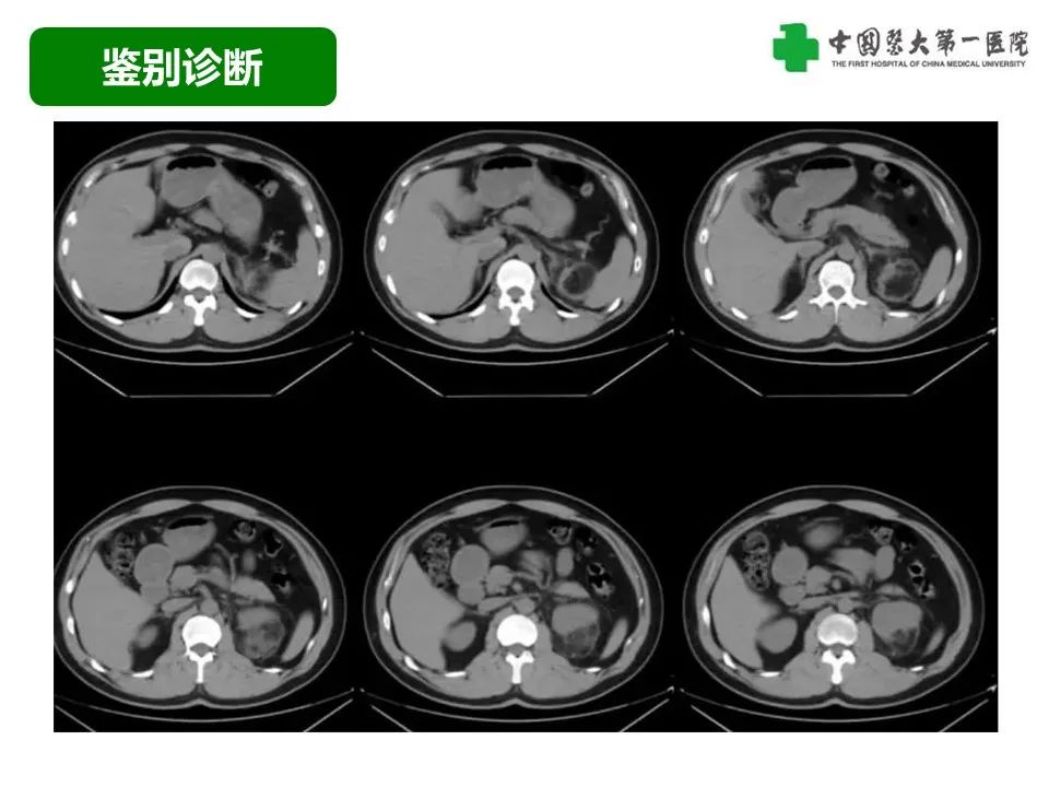 影像PPT - 【病例】腹膜后脂肪肉瘤1例CT影像-43