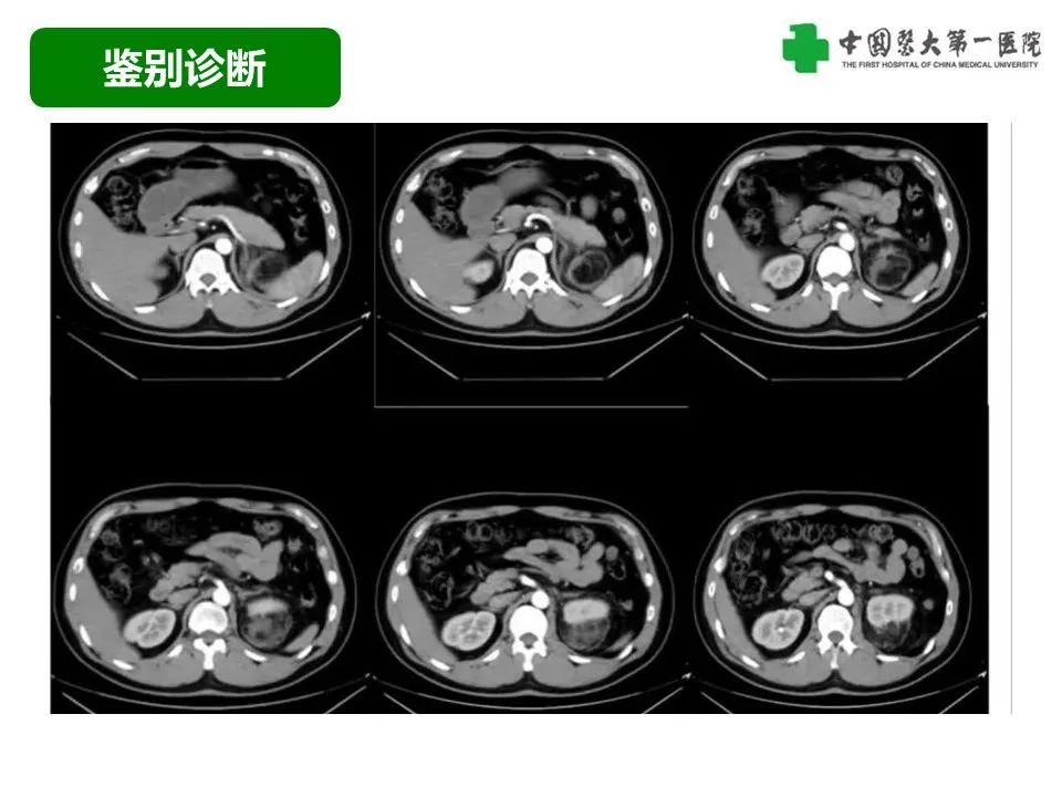 影像PPT - 【病例】腹膜后脂肪肉瘤1例CT影像-44