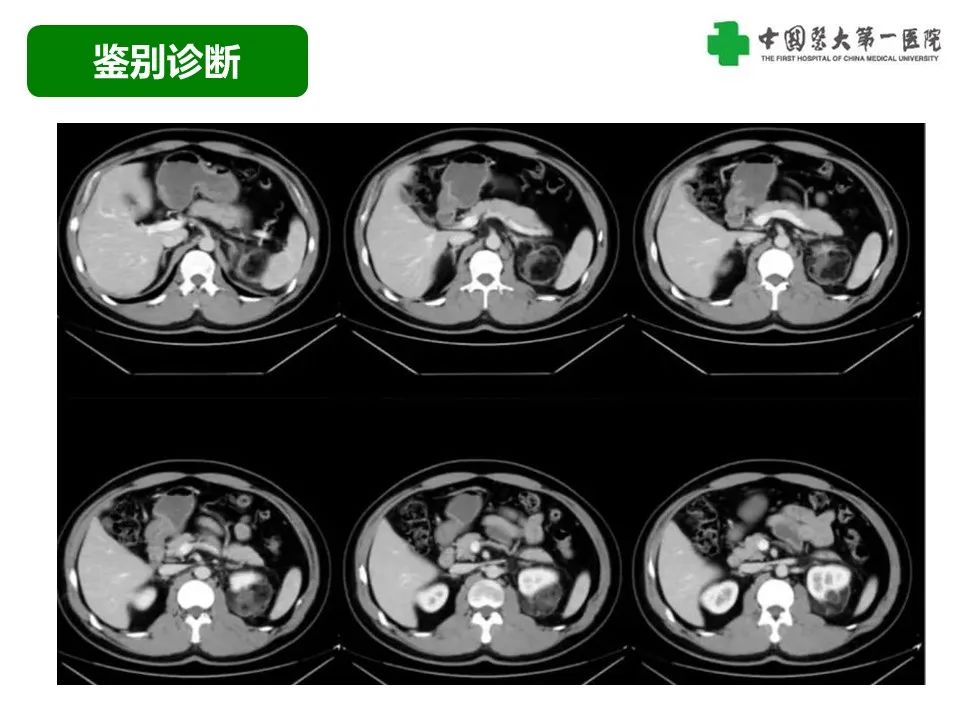 影像PPT - 【病例】腹膜后脂肪肉瘤1例CT影像-45