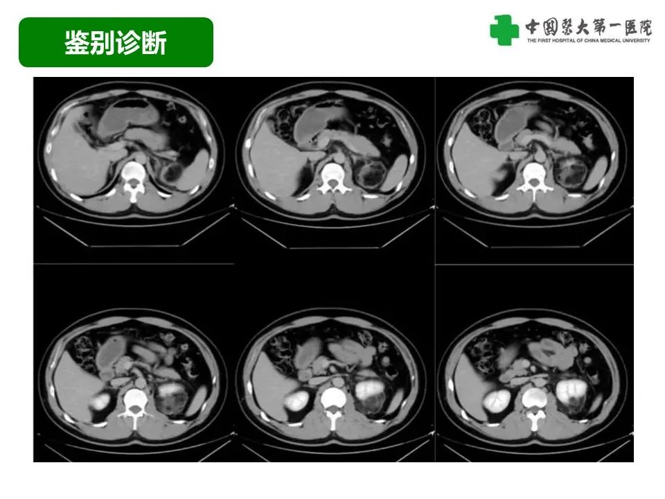 影像PPT - 【病例】腹膜后脂肪肉瘤1例CT影像-46