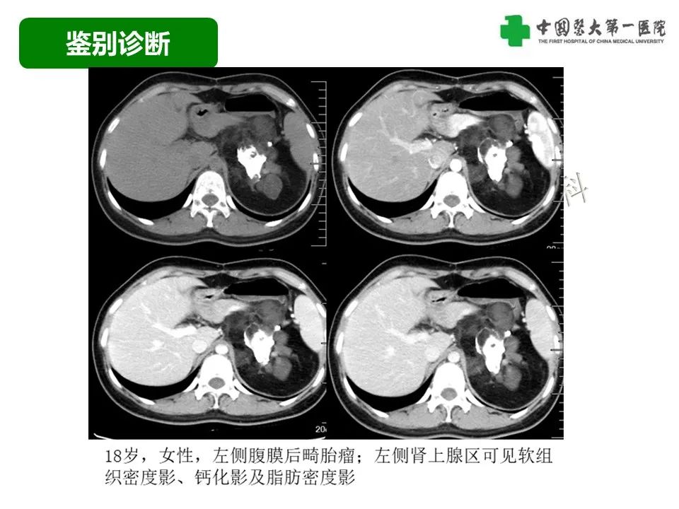 影像PPT - 【病例】腹膜后脂肪肉瘤1例CT影像-48